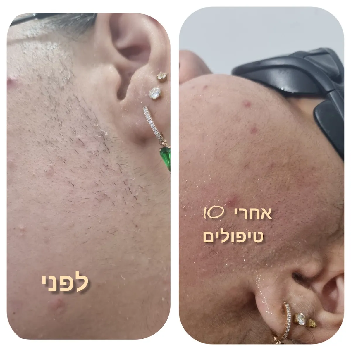 RN laser cosmetic, תמונה 8