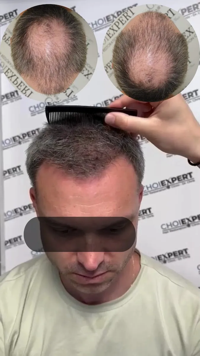ד"ר כריס השתלת שיער CHOIEXPERT, תמונה 6