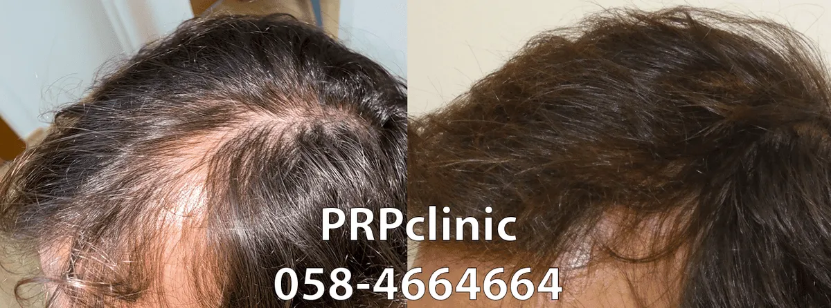 PRPclinic - טיפולי PRP, IPRF ו-CGF לנשירת שיער ואסתטיקה רפואית, תמונה 6