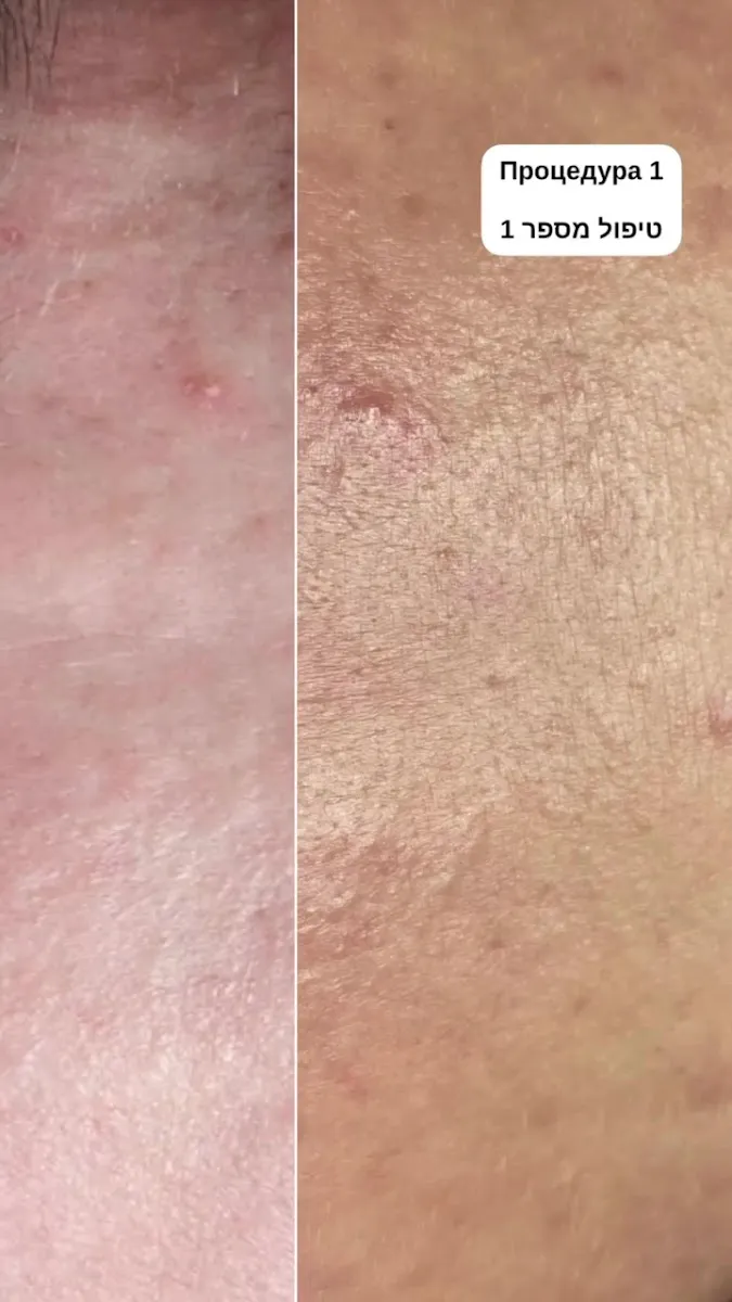 Vita Derm מכון קוסמטיקה בנתניה, תמונה 8