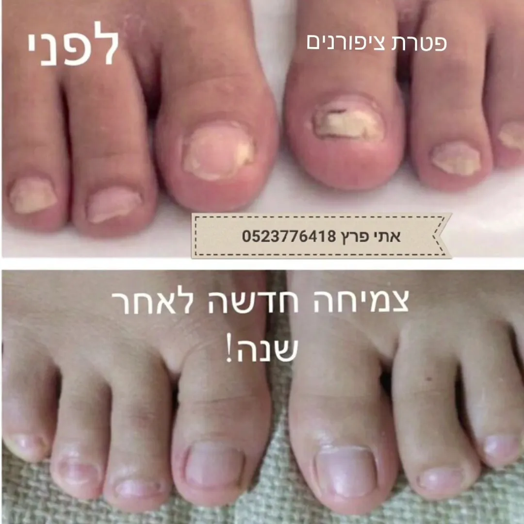 אתי פרץ הסרת שיער בלייזר/ טיפול בפטרת ציפורניים / מחלות עור, תמונה 3