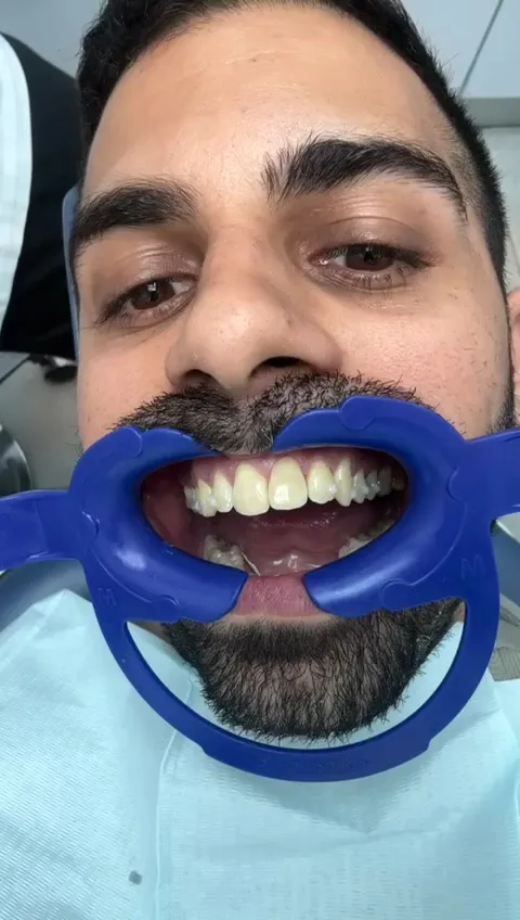 מרפאת שיניים ד"ר אבייב - יישור שיניים שקוף Invisalign בחולון, תמונה 7