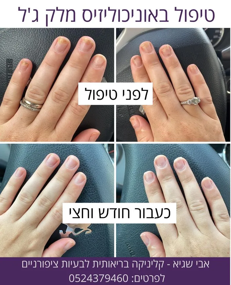 ציפורניים - אבי שגיא - קליניקה בריאותית לציפורניים, תמונה 6