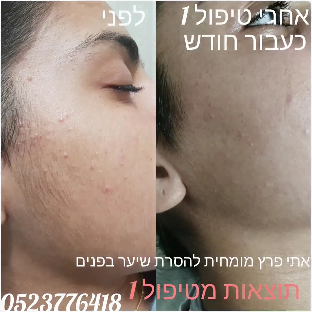 אתי פרץ הסרת שיער בלייזר/ טיפול בפטרת ציפורניים / מחלות עור, תמונה 2