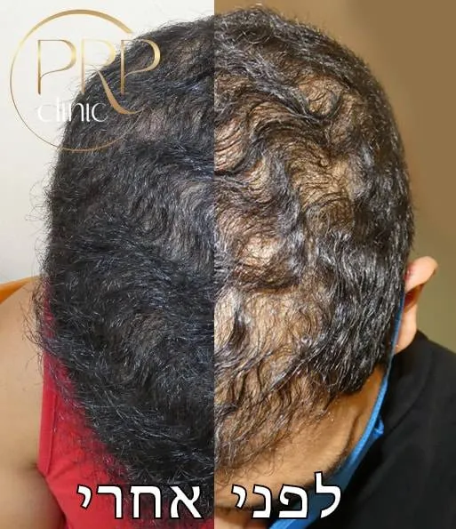 PRPclinic - טיפולי PRP, IPRF ו-CGF לנשירת שיער ואסתטיקה רפואית, תמונה 4
