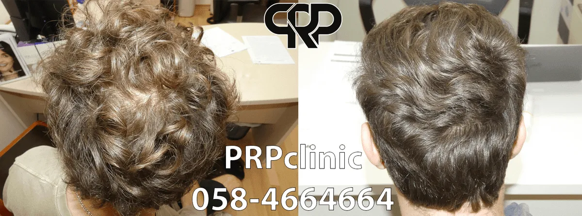 PRPclinic - טיפולי PRP, IPRF ו-CGF לנשירת שיער ואסתטיקה רפואית, תמונה 5