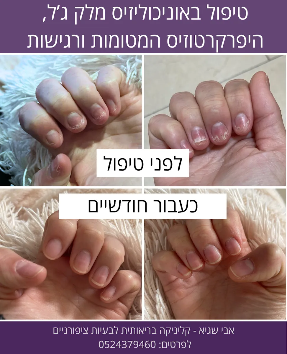 ציפורניים - אבי שגיא - קליניקה בריאותית לציפורניים, תמונה 4