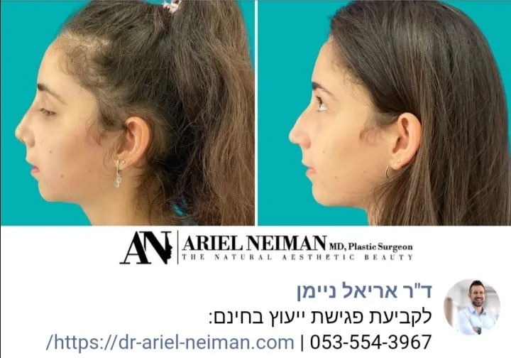 ד"ר אריאל ניימן מומחה לכירורגיה פלסטית, תמונה 4