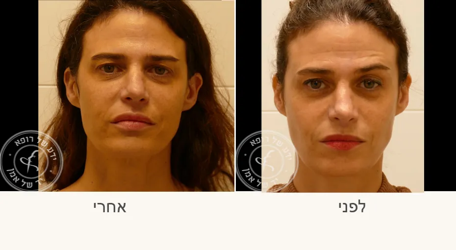 ד״ר בעז אמן כירורגיה פלסטית ואסתטית: תמונה 6
