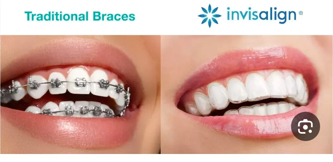 מרפאת שיניים ד"ר אבייב - יישור שיניים שקוף Invisalign בחולון, תמונה 6