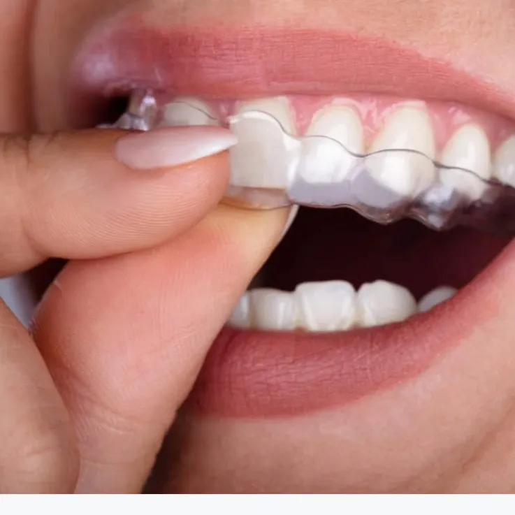 מרפאת שיניים ד"ר אבייב - יישור שיניים שקוף Invisalign בחולון, תמונה 4