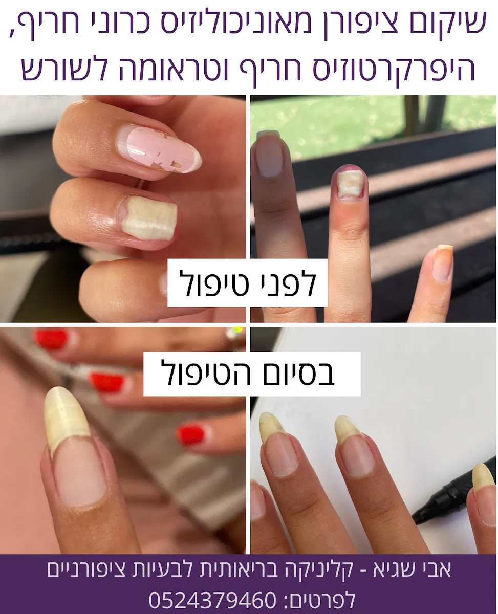 ציפורניים - אבי שגיא - קליניקה בריאותית לציפורניים, תמונה 5