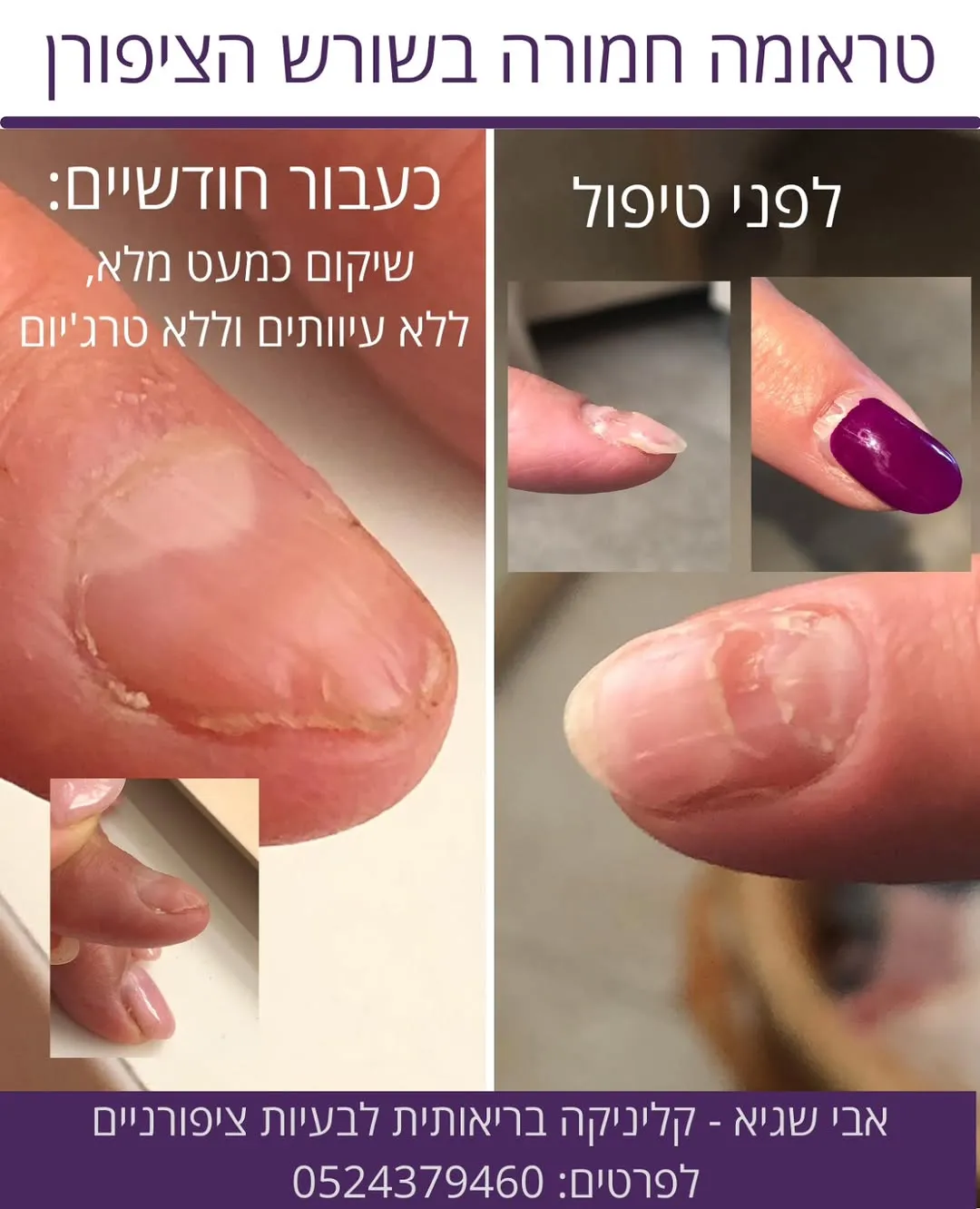 ציפורניים - אבי שגיא - קליניקה בריאותית לציפורניים, תמונה 8