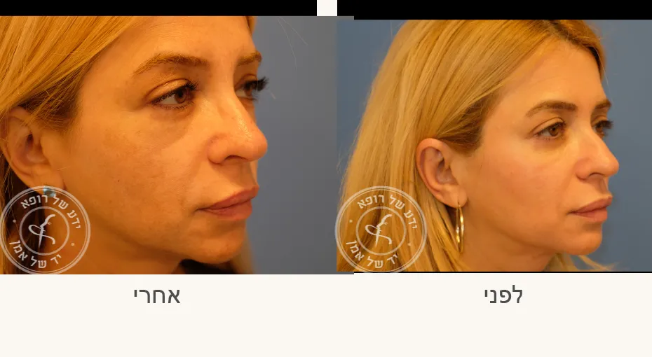 ד״ר בעז אמן כירורגיה פלסטית ואסתטית: תמונה 5