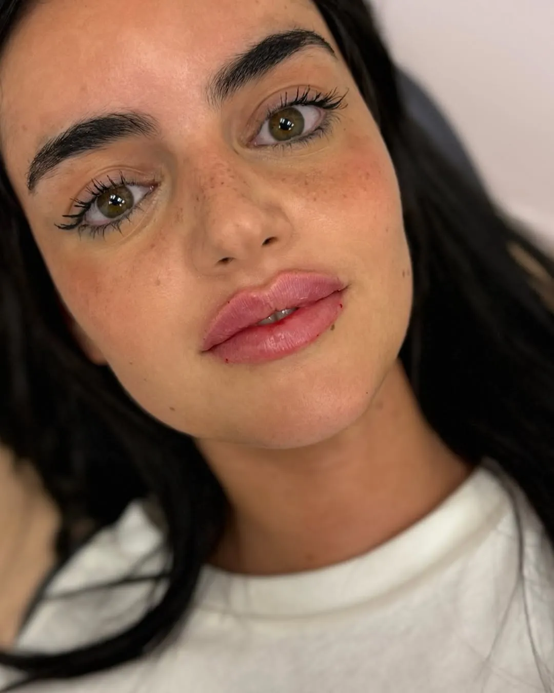 מלכת השפתיים ד"ר מריה זלטקובסקי MEDICAL AESTHETICS, תמונה 8