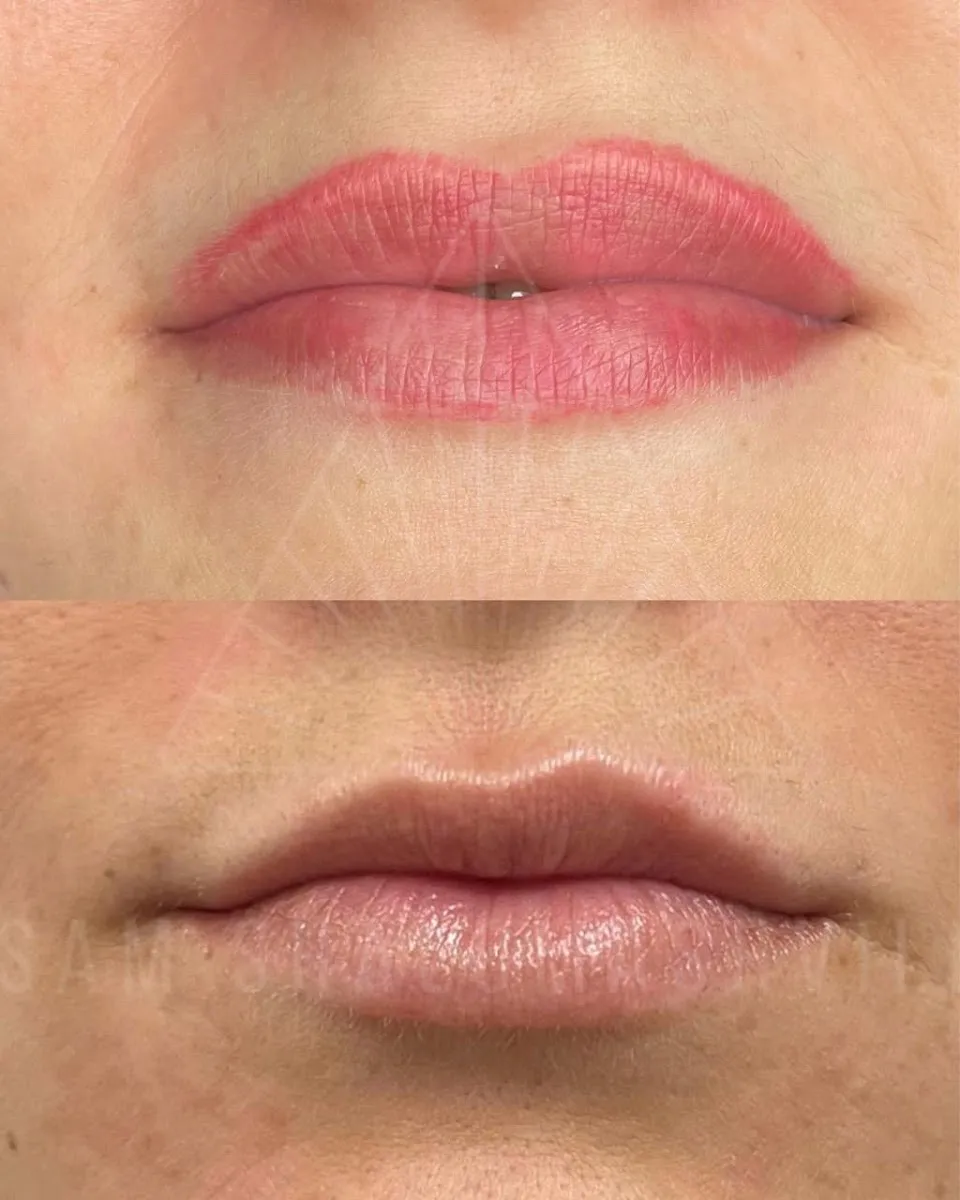 laser removal, תמונה 8