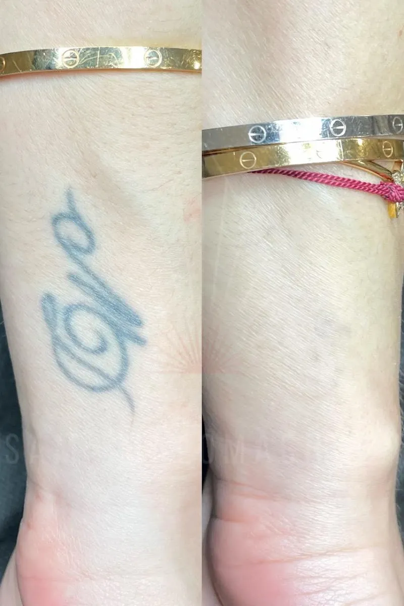 laser removal, תמונה 6