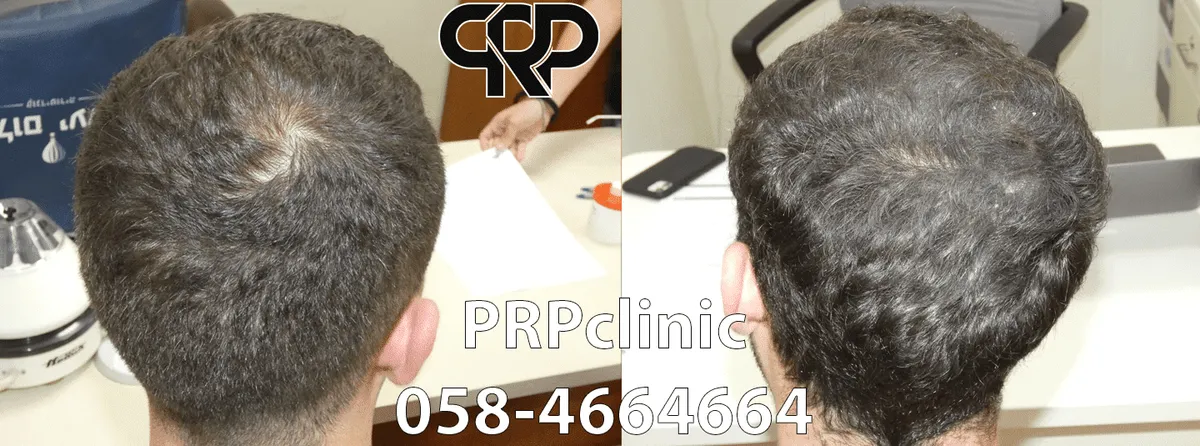 PRPclinic - טיפולי PRP, IPRF ו-CGF לנשירת שיער ואסתטיקה רפואית, תמונה 8