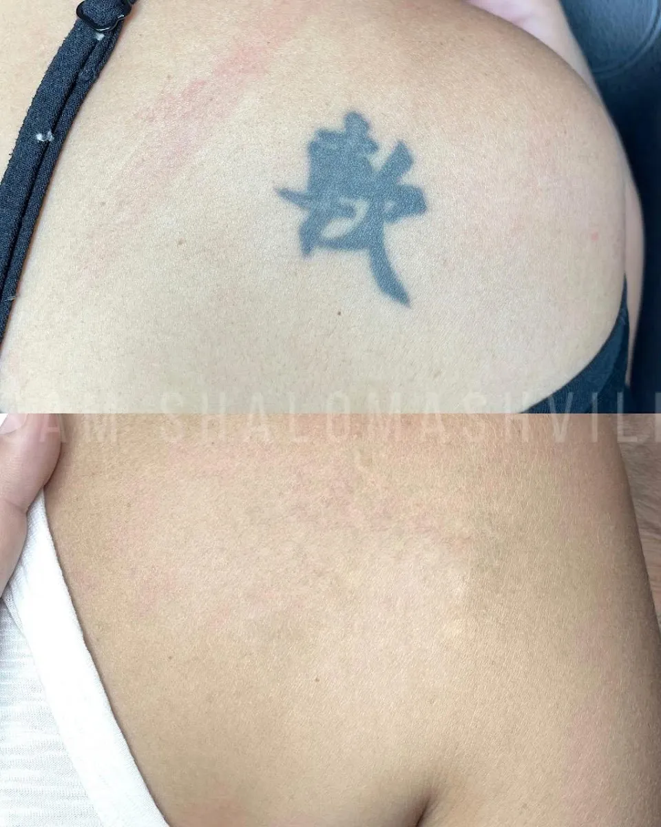 laser removal, תמונה 4
