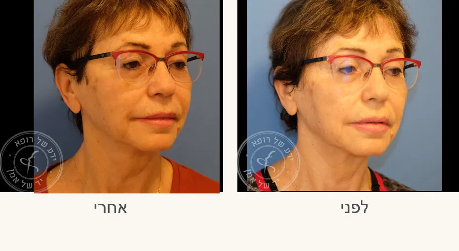 ד״ר בעז אמן כירורגיה פלסטית ואסתטית: תמונה 4