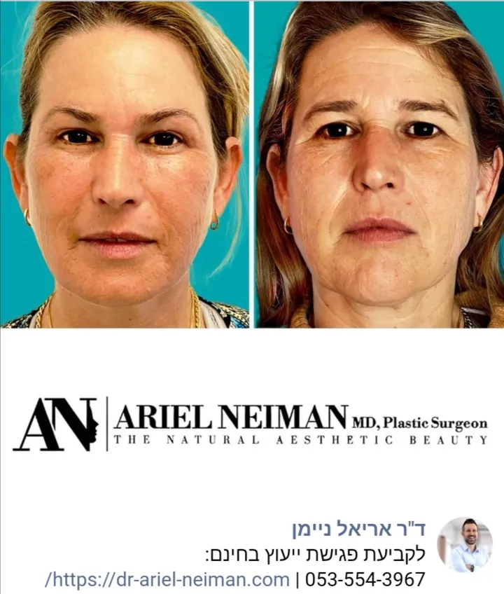 ד"ר אריאל ניימן מומחה לכירורגיה פלסטית, תמונה 5